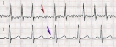 ECG of atrial fibrillation (top) and sinus rhythm (bottom). The purple arrow indicates a P wave, which is lost in atrial fibrillation.(J. Heuser via Wikipedia).